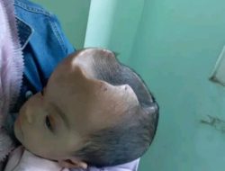 Hidrosefalus di Tengah Rumah Bocor: Aiyla dan Harapan dari Janapria